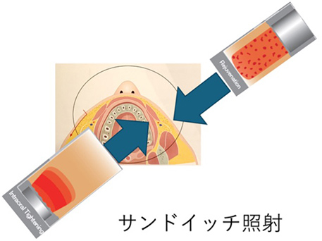 サンドイッチ照射