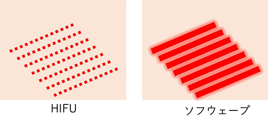 HIFUとソフウェーブの比較