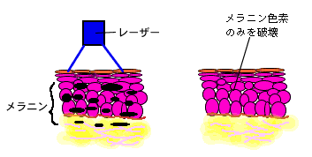 しみ そばかすの最新治療 みやた形成外科 皮ふクリニック