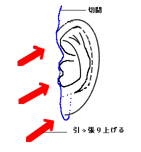 切開によるしわ取り手術のイメージ図