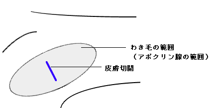 ワキガ手術の模式図　皮膚を切開